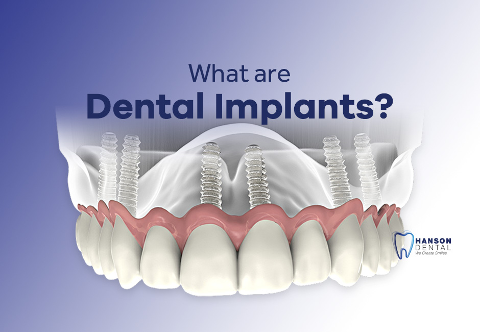 What Are Dental Implants?