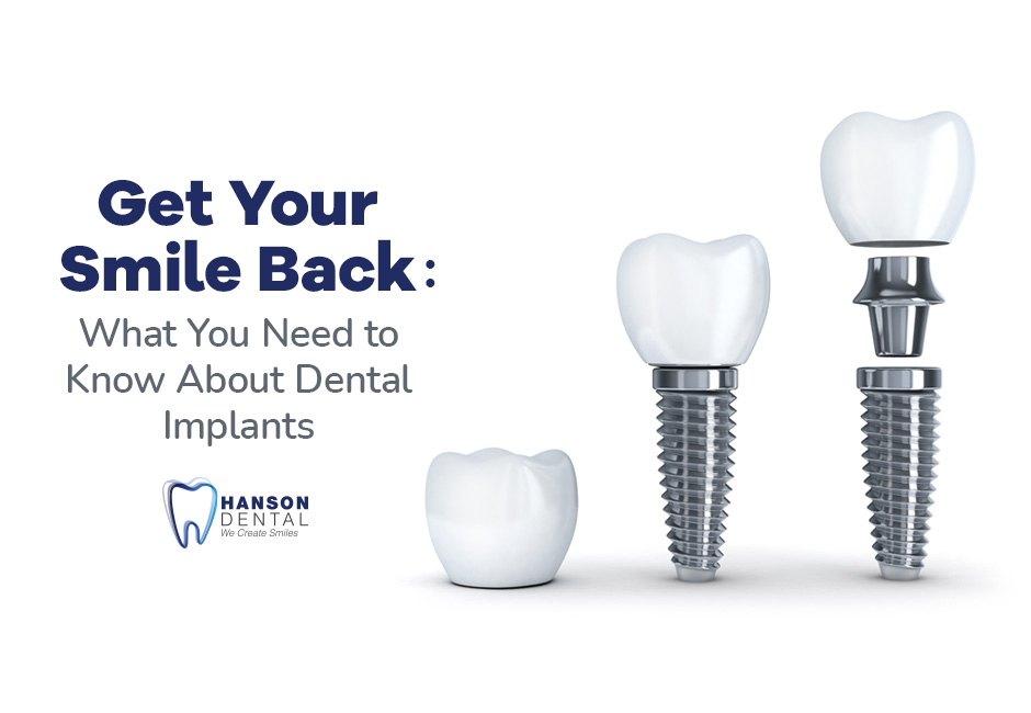 Get Your Smile Back: What You Need to Know About Dental Implants