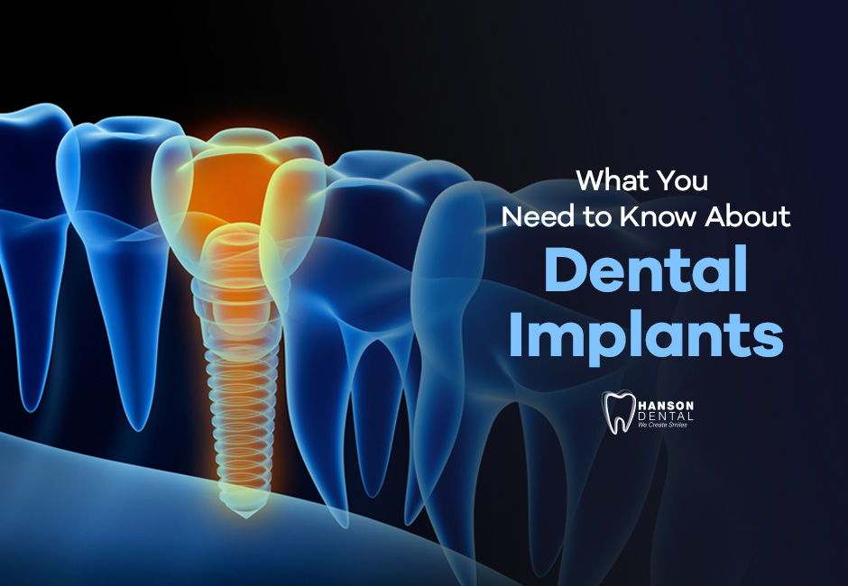 What You Need to Know About Dental Implants