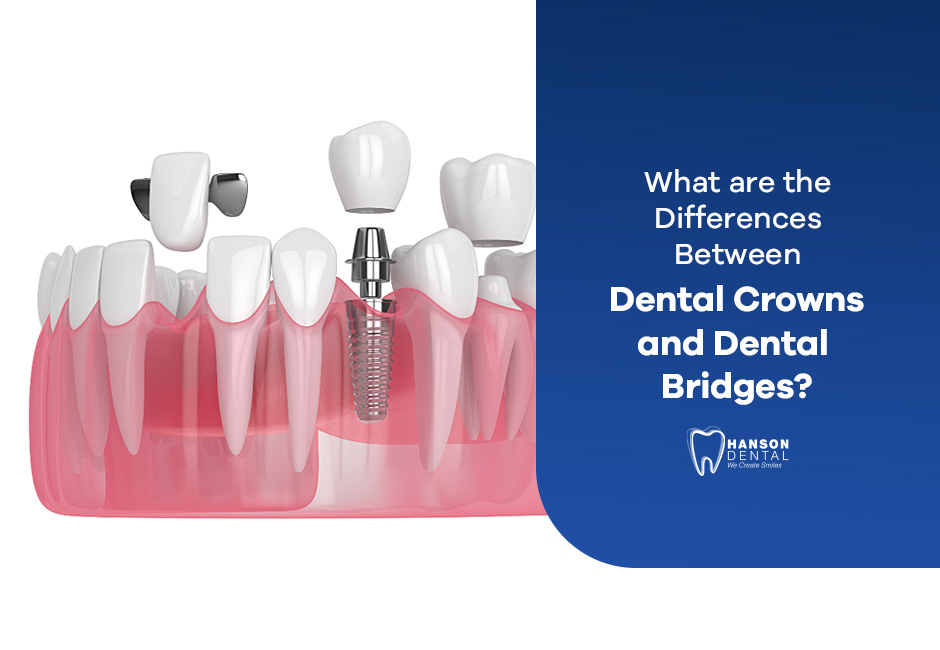 What are the Differences Between Dental Crowns and Dental Bridges?