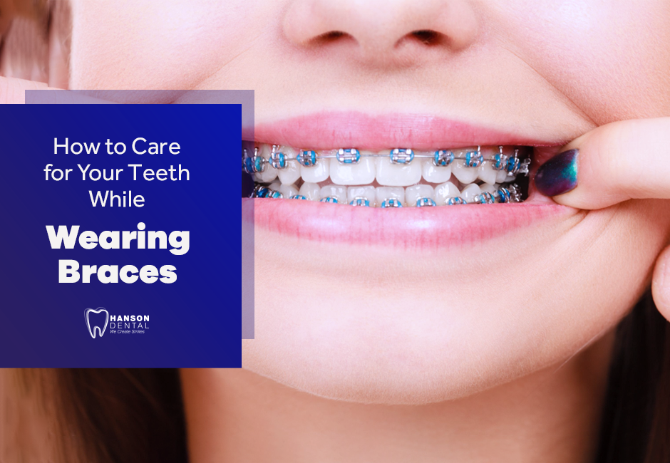 How to Care for Your Teeth While Wearing Braces